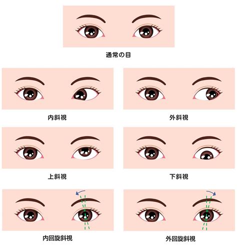 斜視判斷|斜視：成因、病徵及治療